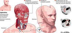 Découvrez la greffe du visage la plus aboutie de l'histoire