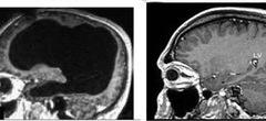 Cet homme au cerveau creux remet tout ce que nous savons sur la conscience en question