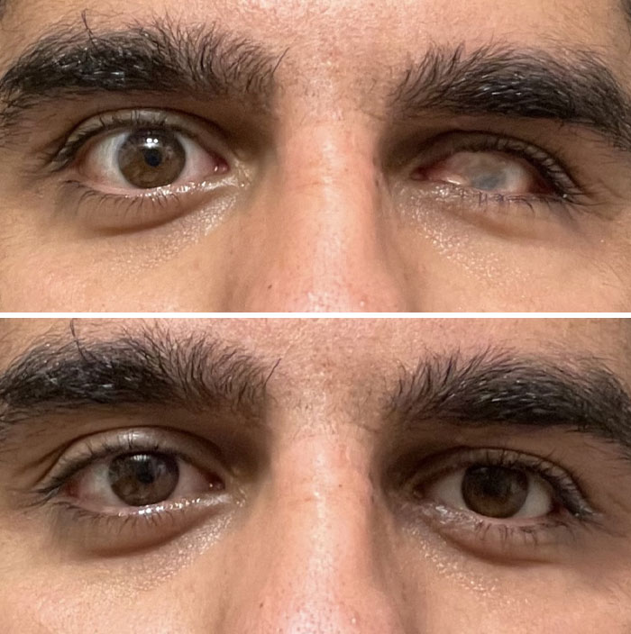 An ocular prosthesis