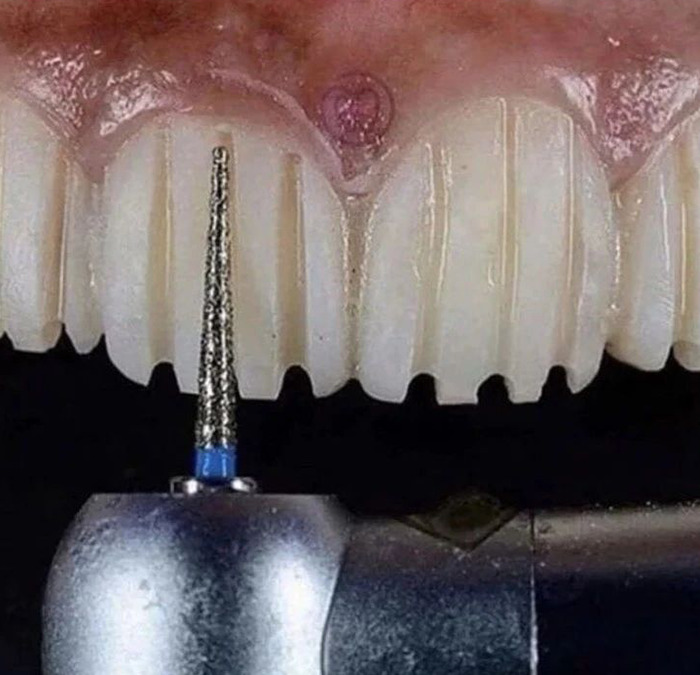 limage de dents