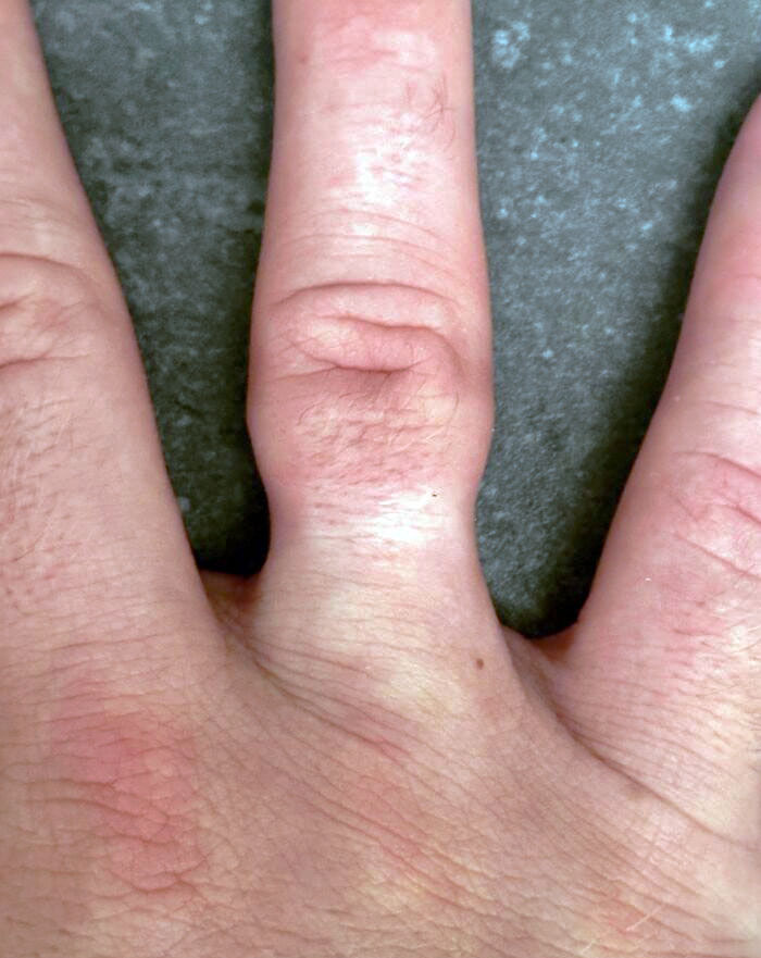 A ring that has been on one finger for too long