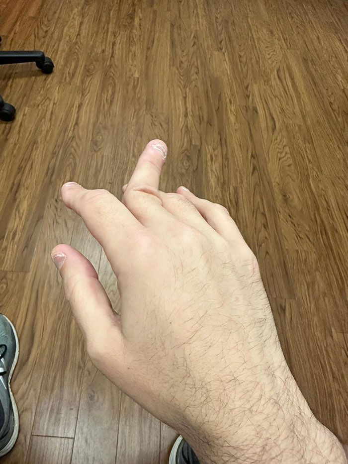 un doigt cassé
