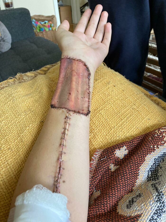 An impressive forearm skin graft which was recently carried out after cancer