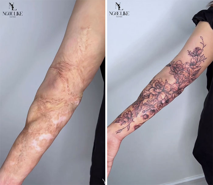 tatouage sur une brulure du bras