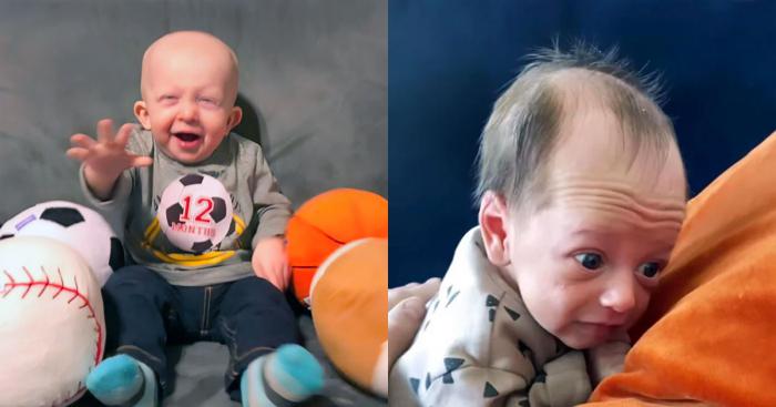 photos de bébé progeria