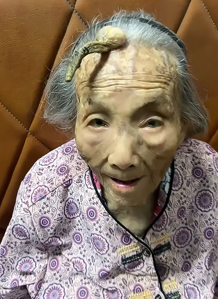 excroissance femme chinoise 107 ans