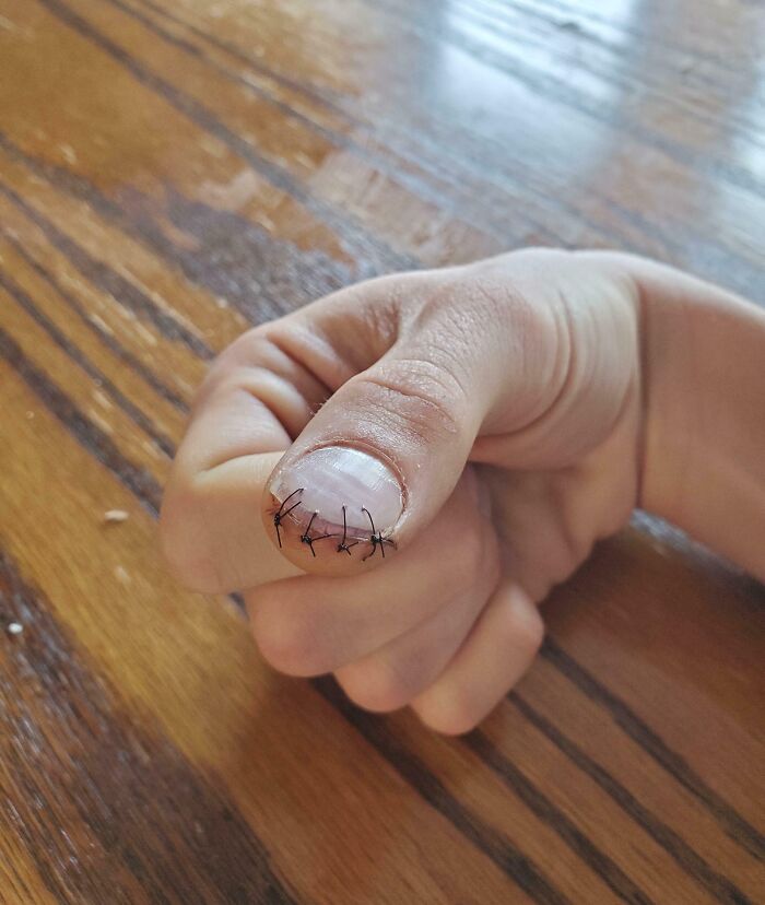 A thumb sewn back together in an original way with his nail