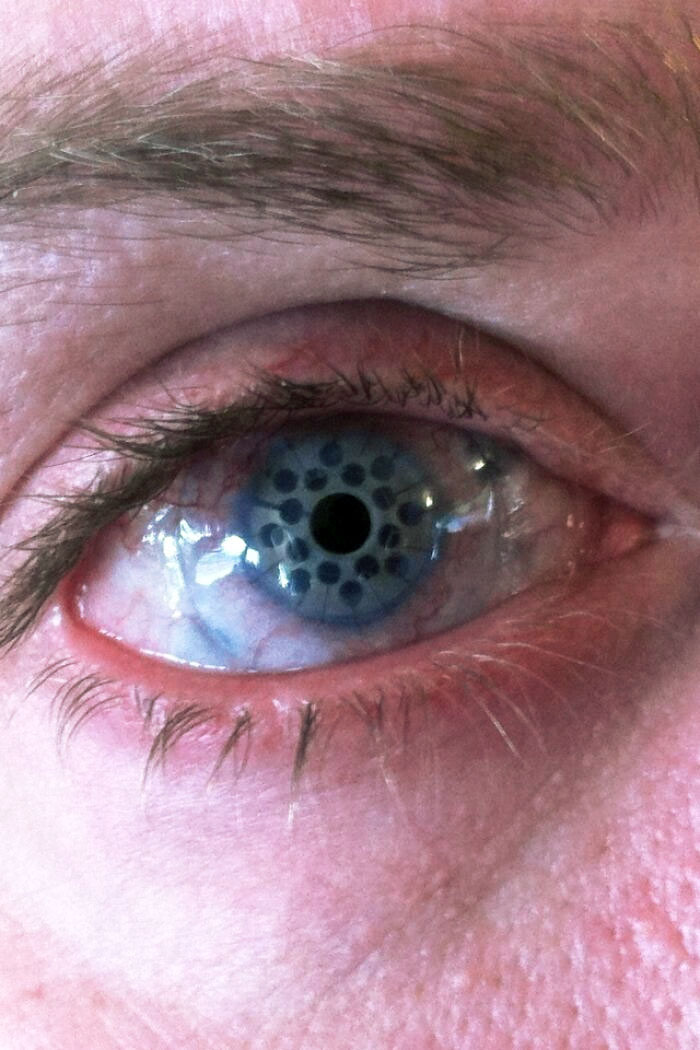 A corneal transplant that gives