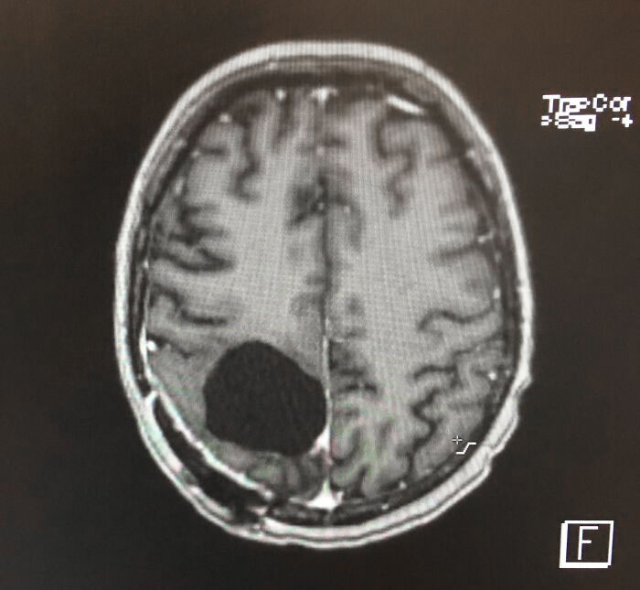 A brain scan after brain surgery to remove a tumor