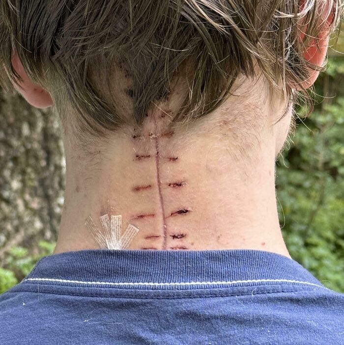 A scar on the neck after an operation to fuse the cervical spine