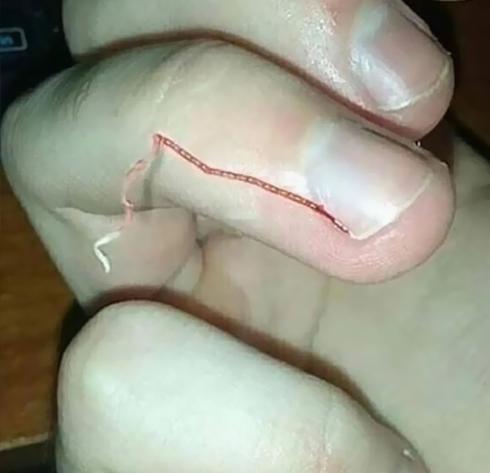 peau arraché sur un doigt