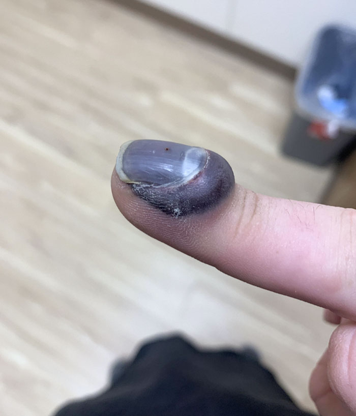 A finger that was crushed by a car door